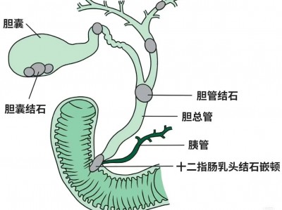 清晰的胆结石出现卡顿时的示意图