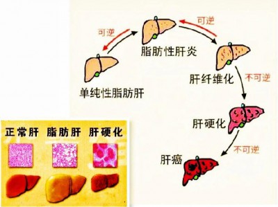 胆囊病友脂肪肝发展图，前期可逆转，后期不可逆转