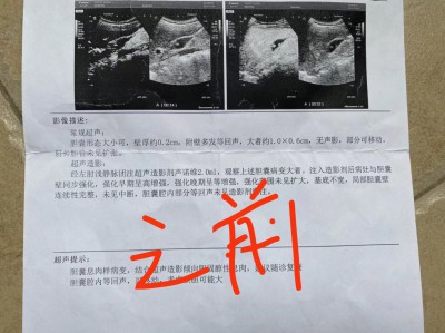 胆囊病友案例：胆囊息肉变小2