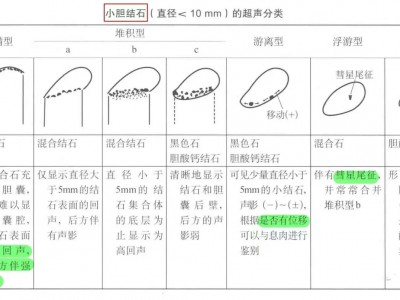胆囊小结石精细分类