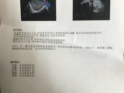 胆囊病友案例：胆结石消失14N