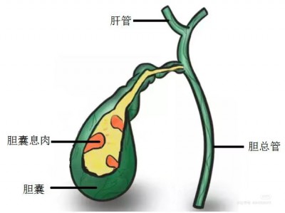 什么是胆囊息肉？