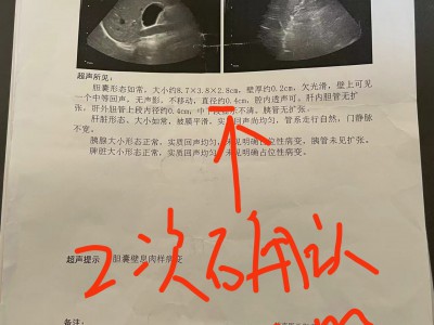 胆囊病友案例：胆囊息肉变小3