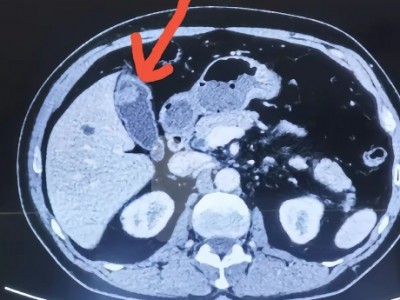 胆囊息肉癌变医学影像参考