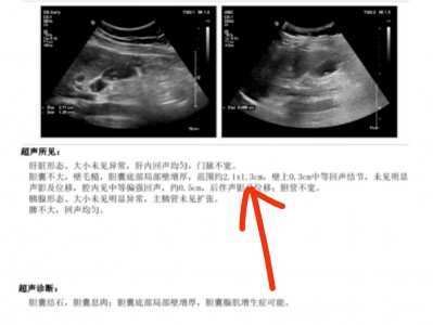 胆囊病友案例：胆囊结石变小-北京N微信好友